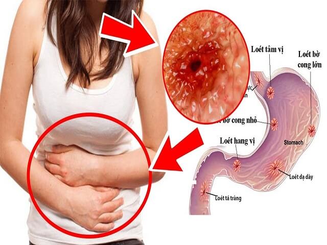 8 dấu hiệu nhận biết bệnh trào ngược dạ dày – thực quản